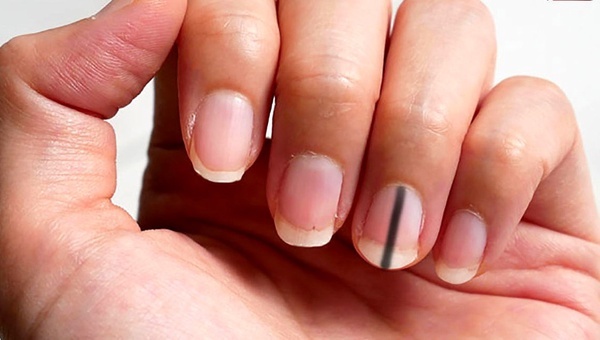 کاشت و لاک ناخن مصنوعی، یکی از دلایل مهم عفونت قارچی
