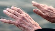 زنان دچار پارکینسون بیشتر در معرض آلزایمر هستند