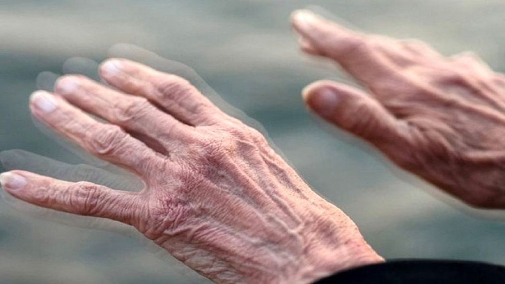 زنان دچار پارکینسون بیشتر در معرض آلزایمر هستند